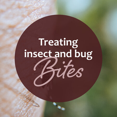 Treating insect and bug bites